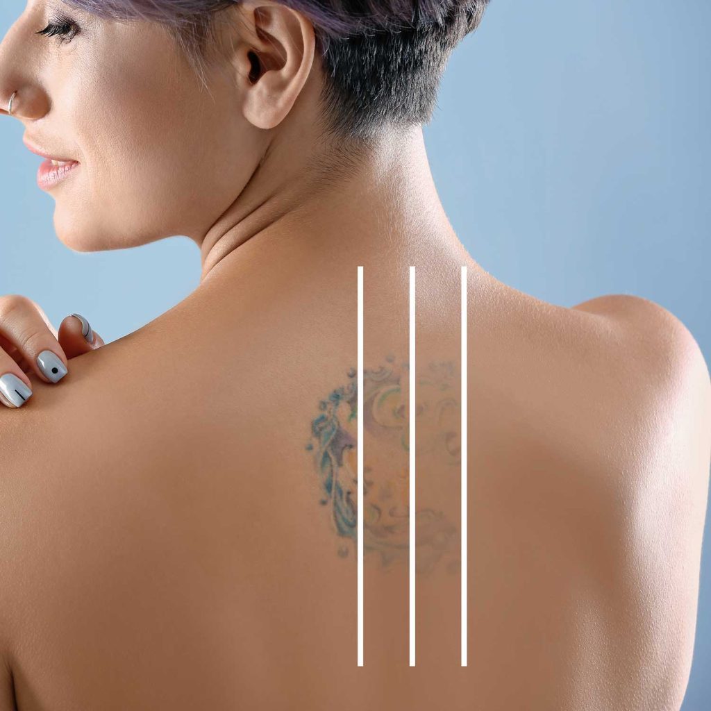 Saline tattoo removal procedure at dagna joanna permanent makeup and beauty in york, uk.