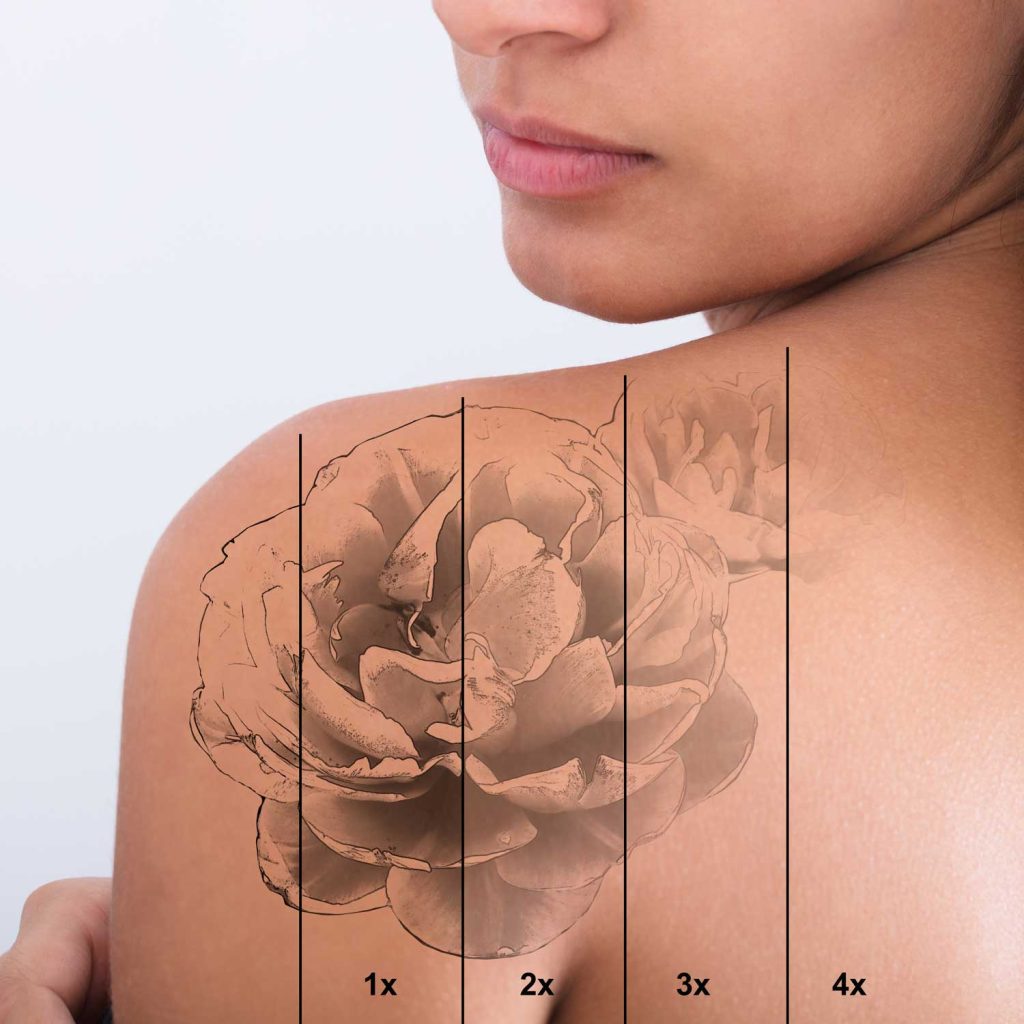 Saline tattoo removal procedure in york – dagna joanna permanent makeup and beauty